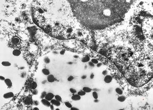 F, 24y. | molluscum contagiosum F, 24y. | molluscum contagiosum